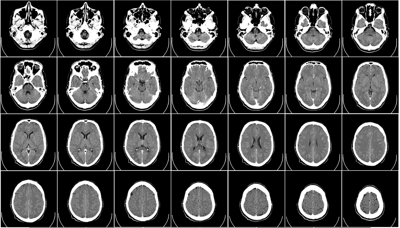 Visualização de uma tomografia computadorizada da cabeça, exibindo imagens das fatias de um crânio humano. É possível identificar com bastante detalhes as estruturas internas da cabeça tal como o cérebro, olhos e a boca.